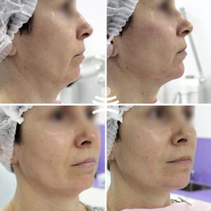 Коррекция подбородка филлерами