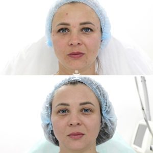 Лазерная шлифовка Фраксель