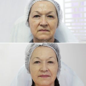 контурная пластика медиэстетик