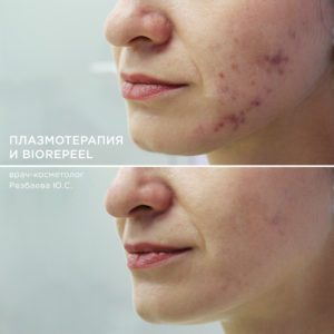 Плазмотерапия