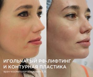 Игольчатый RF лифтинг и контурная пластика лица