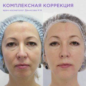 Игольчатый RF-лифтинг и биоревитализация