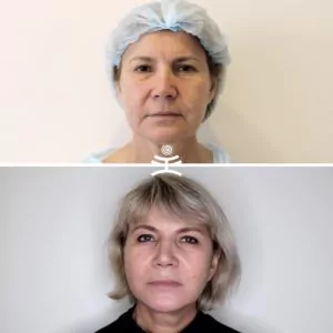 Лифтинг Мендельсона и платизмопластика.