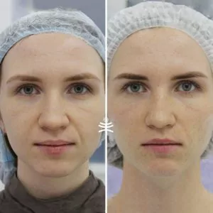 Комплексная коррекция лица