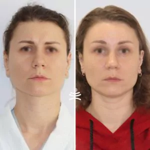Эндоскопическая подтяжка лба