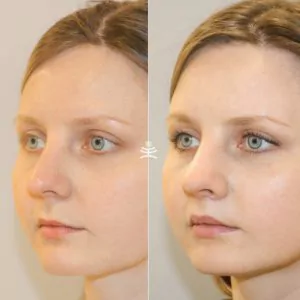 Хейлопластика и булхорн