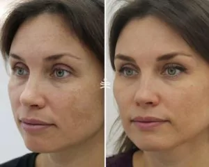 Игольчатый лифтинг, биоревитализация, ботулинотерапия, фототерапия