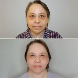 Комплексный лифтинг лица
