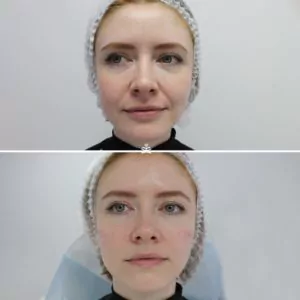 Контурная пластика скул, Диспорт
